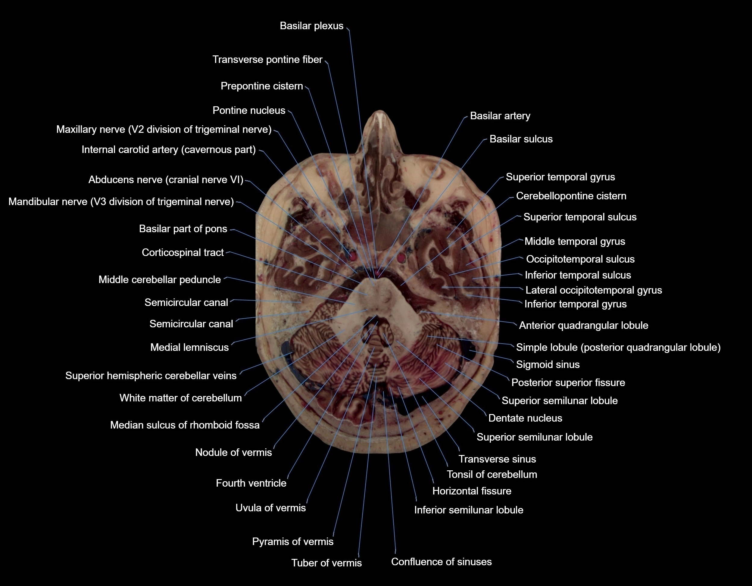 MRI Brain axial cross sectional radiology anatomy 3T image  -img-000021.webp